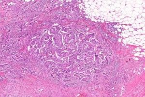 cancer_mastos