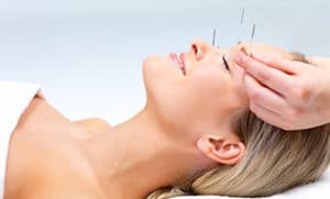 Acupuncture therapy of a young woman