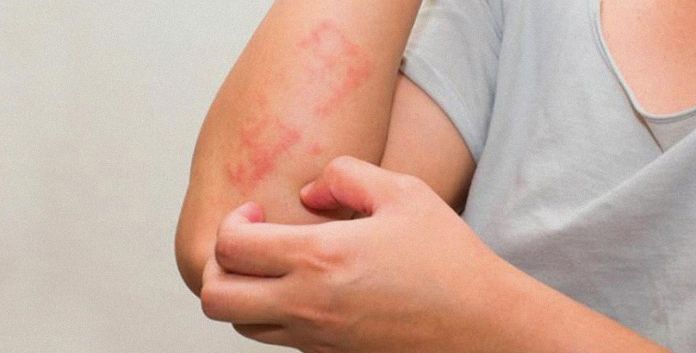 Ψωρίαση: Νέες θεραπείες αλλάζουν τη ζωή των ασθενών Ψωρίαση: Νέες θεραπείες αλλάζουν τη ζωή των ασθενών