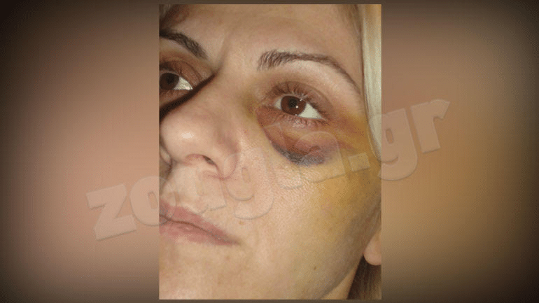 Υποψήφιος δήμαρχος που καταδικάστηκε τελεσίδικα για ξυλοδαρμό γυναίκας πήρε εκ νέου το χρίσμα από τη ΝΔ Υποψήφιος δήμαρχος που καταδικάστηκε τελεσίδικα για ξυλοδαρμό γυναίκας πήρε εκ νέου το χρίσμα από τη ΝΔ