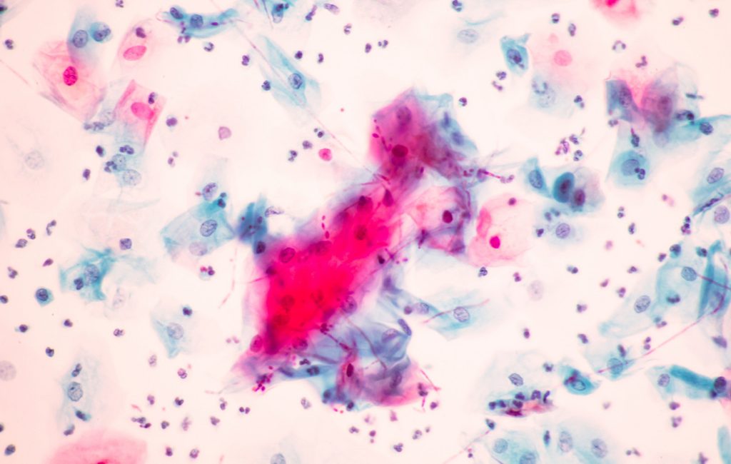 Ανησυχία για τα «superbugs» στη Νέα Υόρκη – Αύξηση των κρουσμάτων του Candida auris και προειδοποιήσεις ειδικών για την ανθεκτικότητα στα αντιβιοτικά